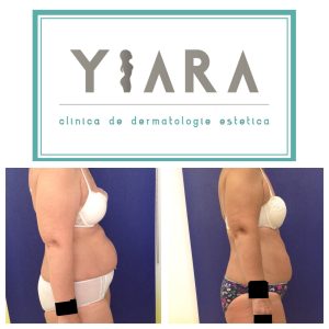 velashape testimoniale clinica de dermatologie estetica yiara pentru celulita reducere in cm si laxitatea pielii