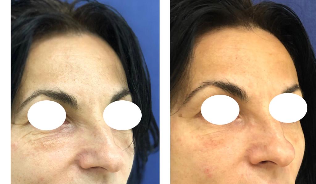 tratament laser rejuvenare faciala
