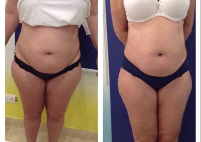 6 x Accent Prime + 8 x Cryolipolysis
