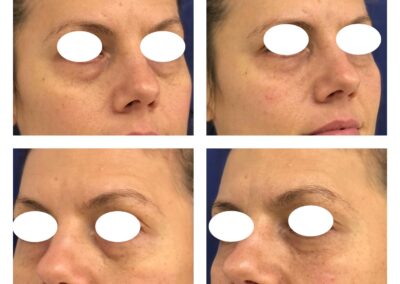 Hyaluronic Acid treatment - Reducing dark circles under the eye