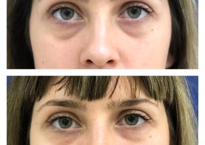 Hyaluronic Acid treatment - Reducing dark circles under the eye