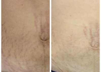 Stretch marks treatment - 4 sessions