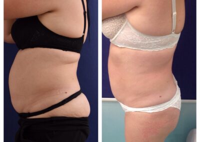 4 x Cryolipolysis + 6 x Accent Prime