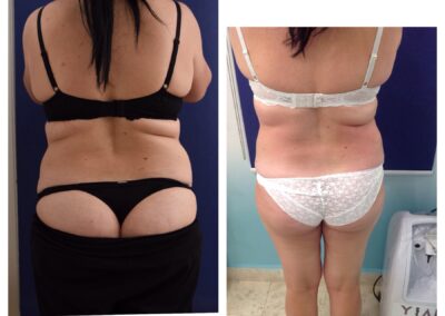 4 x Cryolipolysis + 6 x Accent Prime