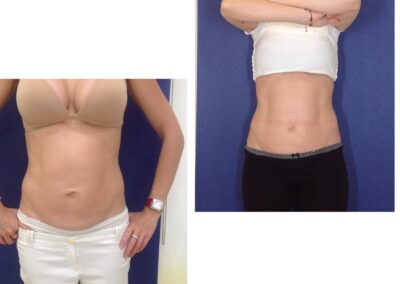 Tratament Accent Prime - 6 sedinte abdomen