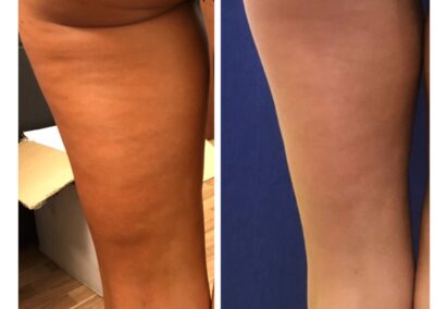 Tratament Celulita - Accent Prime - 6 sedinte