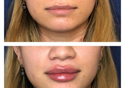 Marire Buze - Acid Hialiuronic