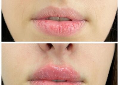 Marire Buze - Acid Hialiuronic Aspect Natural - Russina Lips