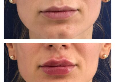 Marire Buze - Acid Hialiuronic - Russian Lips